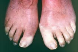 raynor disease